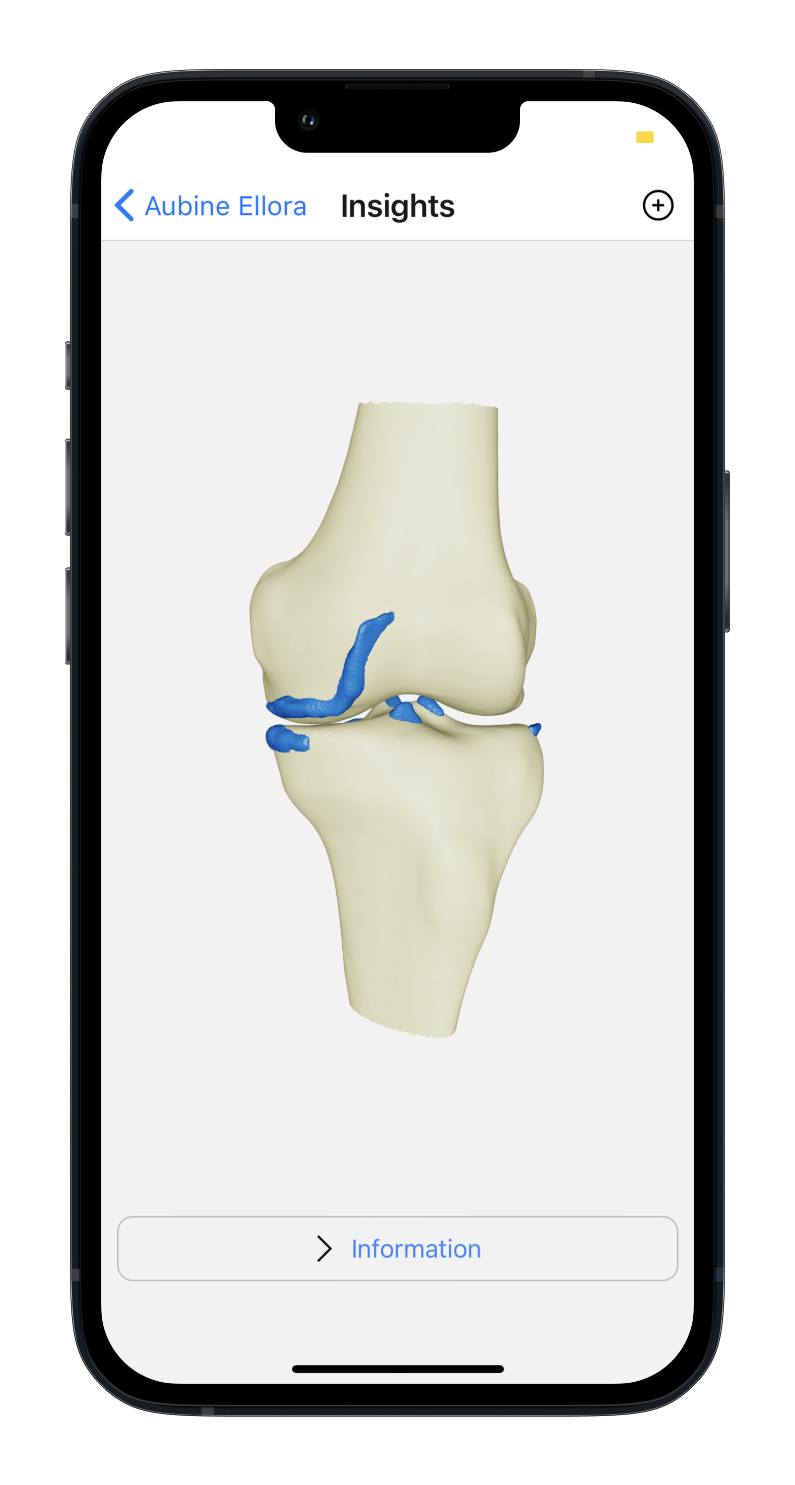 SOLID Insights 3D knee view